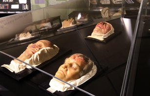Wachsmoulagen zeigen verschiedene Syphilis-Symptome auf drei Gesichtern  in einer dunklen Vitrine.